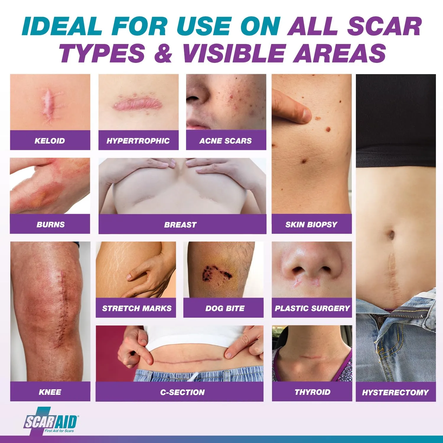 Silicone Scar Gel for Scars After Surgery, C Section Scar & Deep Scar Removal, Silicone Stick, Silicone Scar Gel for Surgical Scars & Keloid Scar Treatment, Silicone Gel for Scars After Surgery, 4.25g
