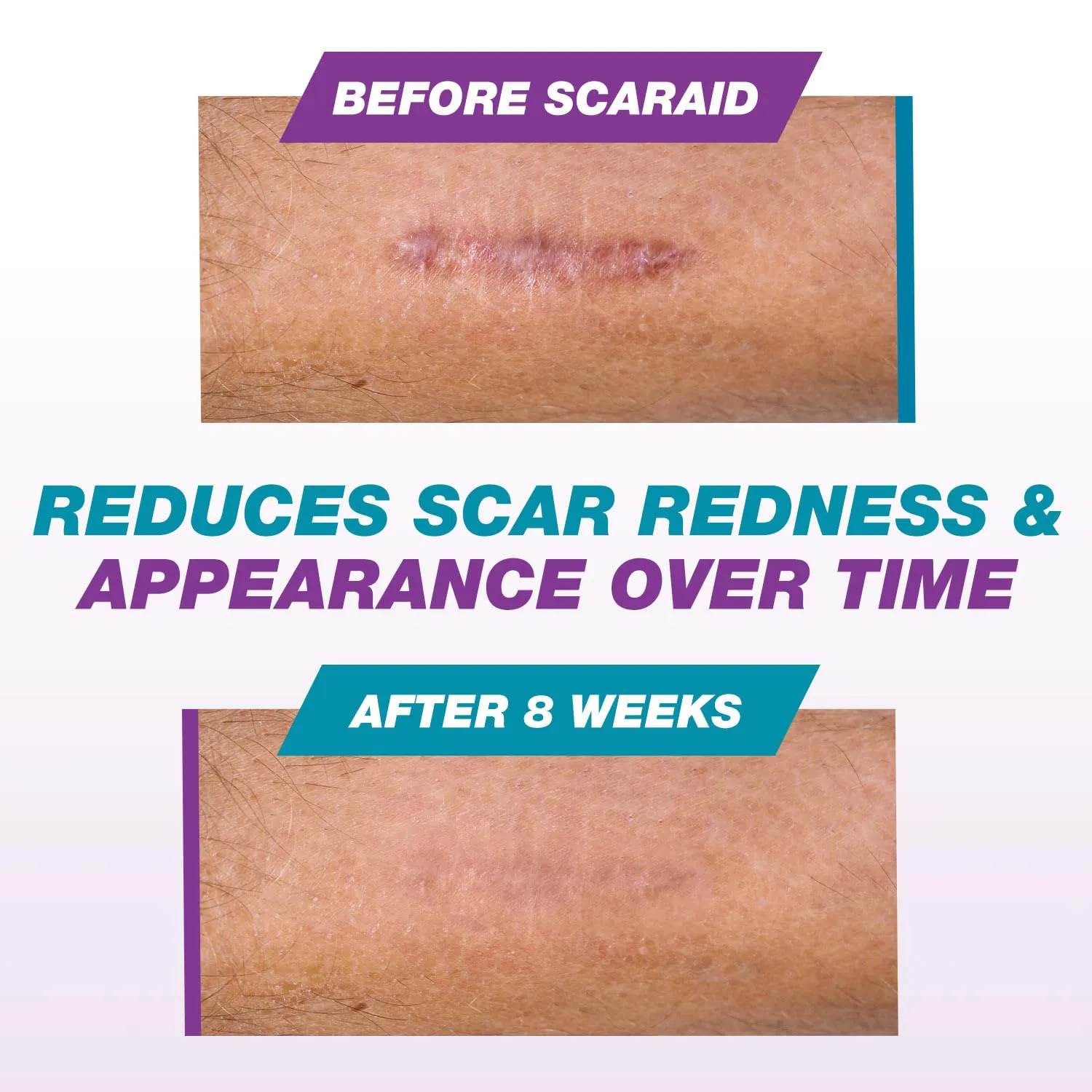 Silicone Scar Gel for Scars After Surgery, C Section Scar & Deep Scar Removal, Silicone Stick, Silicone Scar Gel for Surgical Scars & Keloid Scar Treatment, Silicone Gel for Scars After Surgery, 4.25g